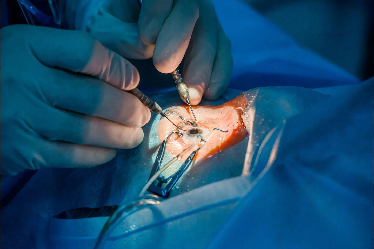 Trasplante de córnea en quirófano especializado, cirugía ocular realizada por el Dr. Francisco Alain Matabuena en Querétaro y Celaya